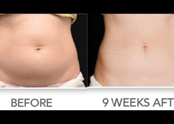 Liposuction Surgery in Miami