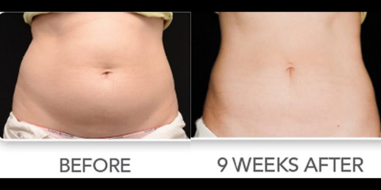 Liposuction Surgery in Miami