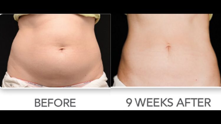 Liposuction Surgery in Miami